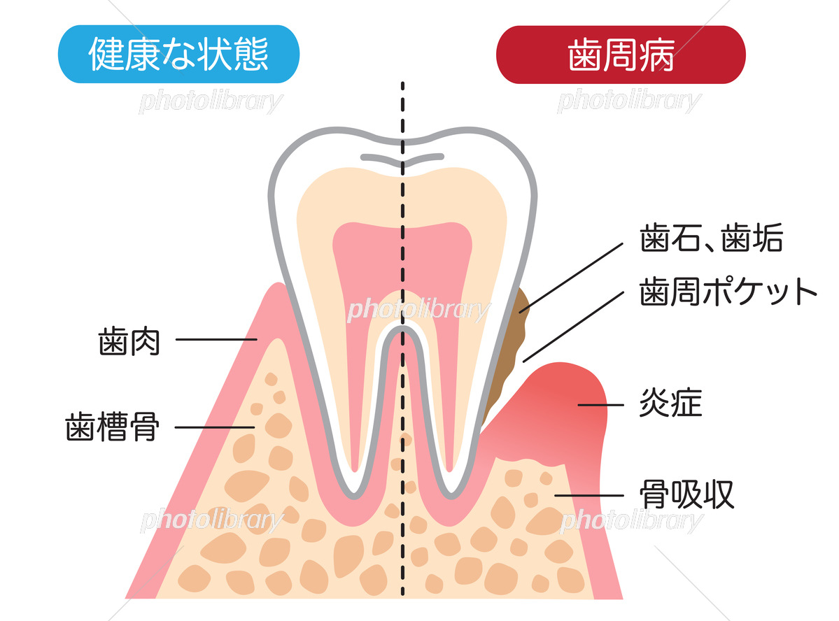 歯周病について かさはら歯科医院 宮城県仙台市の歯医者