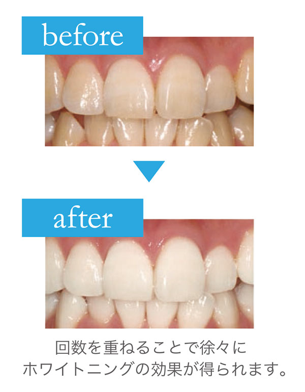 ホワイトニング before after